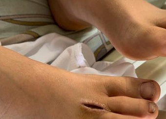 Спасти жизнь мальчика после заражения столбняком удалось врачам ИКБ №1 